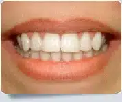 Veneer Dentists Toronto