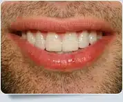 Veneer Dentists Toronto 4