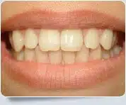 Veneer Dentists Toronto 2