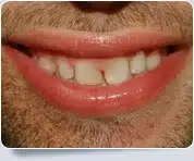 Veneer Dentists Toronto3