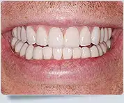 Veneer Dentists Toronto 6