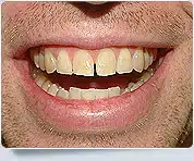 Veneer Dentists Toronto 5