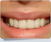 Veneer Dentists Toronto 2
