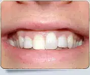 Veneer Dentists Toronto