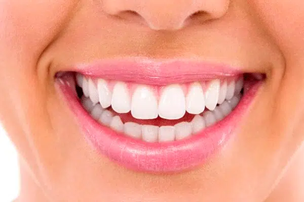 Professional Teeth Whitening in Toronto