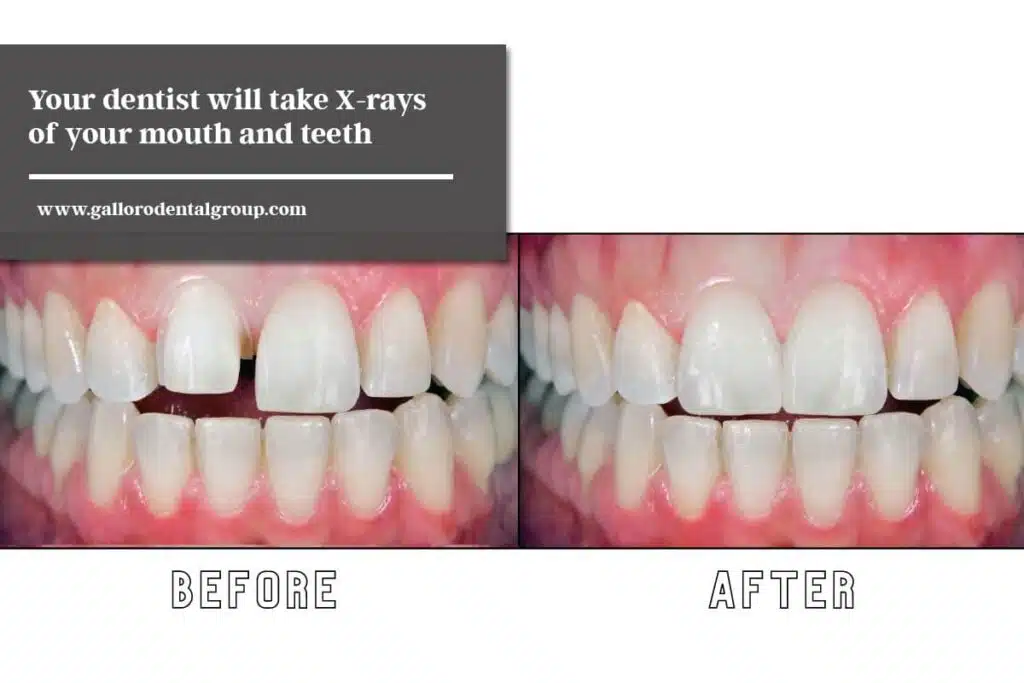 Your-dentist-will-take-X-rays-of-your-mouth-and-teeth