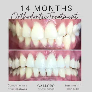 Orthodontic Treatment Toronto Summer Hill and Don Mills