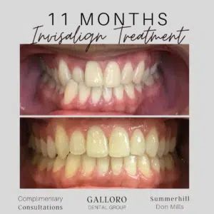 Invisalign Treatment Toronto Summer Hill and Don Mills