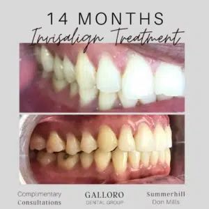 Invisalign Treatment Toronto Summer Hill and Don Mills