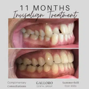 Invisalign Treatment Toronto Summer Hill and Don Mills