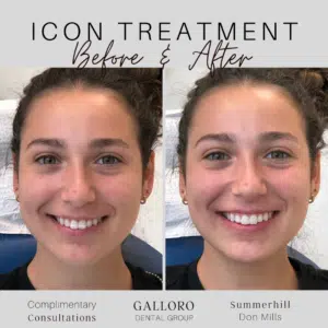 Icon Treatment Toronto