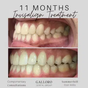 Invisalign Treatment Toronto Summer Hill and Don Mills