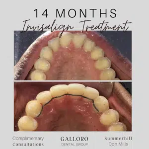 Invisalign Treatment Toronto Summer Hill and Don Mills