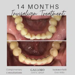 Invisalign Treatment Toronto Summer Hill and Don Mills