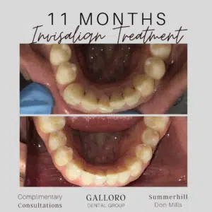 Invisalign Treatment Toronto Summer Hill and Don Mills